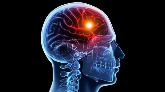 brain with red dot showing stroke