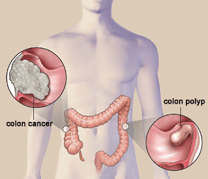 Illustration with examples of colon cancer and colon polyp