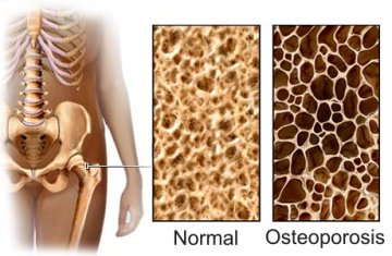 Examples of normal bone structure and Osteoporosis structure